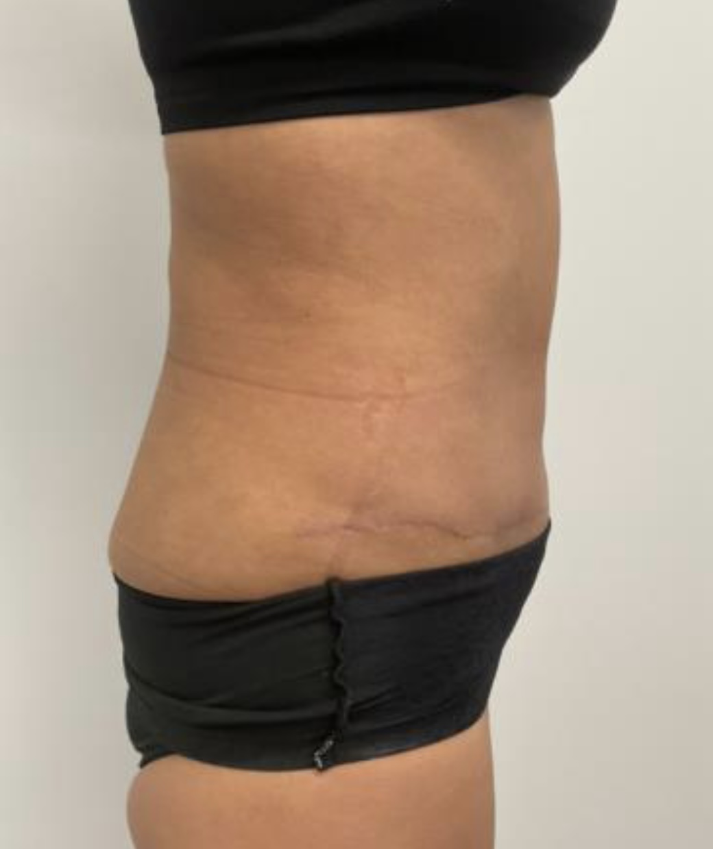 But Tuck Tummy Tuck Archives - Angela Champion, MD